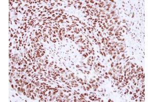 IHC-P Image Immunohistochemical analysis of paraffin-embedded human breast cancer, using SNRPA, antibody at 1:250 dilution. (SNRPA1 anticorps  (C-Term))