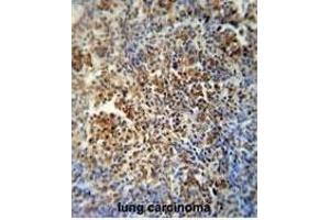 F1 antibody (Center) (ABIN654163 and ABIN2844027) immunohistochemistry analysis in forlin fixed and paraffin embedded hun lung carcino followed by peroxidase conjugation of the secondary antibody and DAB staining.