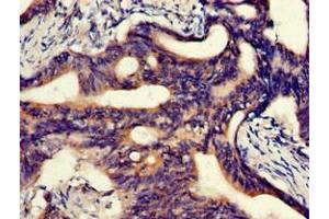 Immunohistochemistry of paraffin-embedded human colon cancer using ABIN7144881 at dilution of 1:100 (ABCA5 anticorps  (AA 1230-1355))