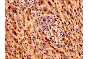 Immunohistochemistry of paraffin-embedded human liver cancer using ABIN7162762 at dilution of 1:100