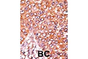 Formalin-fixed and paraffin-embedded human cancer tissue reacted with CDKN1B (phospho T157) polyclonal antibody  which was peroxidase-conjugated to the secondary antibody followed by AEC staining. (CDKN1B anticorps  (pThr157))