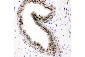 Anti-VCP antibody, IHC(P) IHC(P): Human Mammary Cancer Tissue (VCP anticorps  (C-Term))