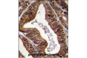 EII Antibody (C-term) 11233b immunohistochemistry analysis in formalin fixed and paraffin embedded human prostate carcinoma followed by peroxidase conjugation of the secondary antibody and DAB staining.