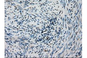 Immunohistochemical staining of paraffin-embedded Carcinoma of thyroid tissue using anti-STK39mouse monoclonal antibody.