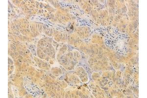 ABIN6261619 and ABIN6276751 at 1/100 staining human lung adenocarcinoma by IHC-P. (ETS1 anticorps  (Internal Region))