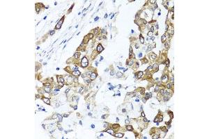 Immunohistochemistry of paraffin-embedded human colon carcinoma using PPOX antibody (ABIN6129092, ABIN6146051, ABIN6146052 and ABIN6222026) at dilution of 1:100 (40x lens).