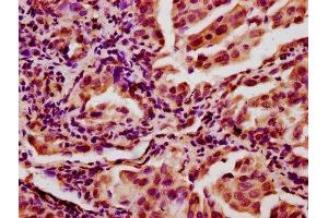 IHC image of ABIN7147681 diluted at 1:400 and staining in paraffin-embedded human lung cancer performed on a Leica BondTM system.