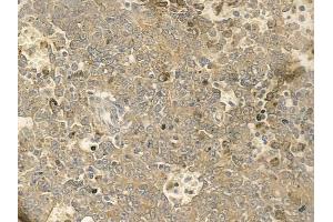 ABIN6259273 and ABIN6273655 at 1/100 staining human melanoma by IHC-P. (FIL1h anticorps  (C-Term))