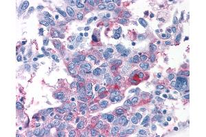 Anti-T1R1 / TAS1R1 antibody IHC of human Ovary, Carcinoma. (TAS1R1 anticorps  (N-Term))