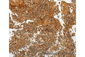Immunohistochemistry of Human ovarian cancer using TFF2 Polyclonal Antibody at dilution of 1:40