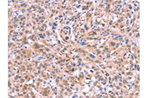 The image on the left is immunohistochemistry of paraffin-embedded Human esophagus cancer tissue using ABIN7128670(BMPR2 Antibody) at dilution 1/35, on the right is treated with fusion protein. (BMPR2 anticorps)