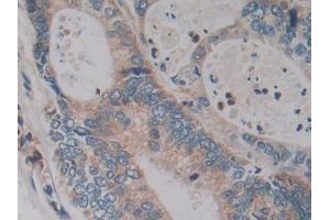 Detection of KLK2 in Human Colorectal cancer Tissue using Polyclonal Antibody to Kallikrein 2 (KLK2)