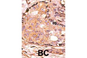 Formalin-fixed and paraffin-embedded human breast cancer tissue reacted with DUSP4 polyclonal antibody  , which was peroxidase-conjugated to the secondary antibody, followed by AEC staining. (DUSP4 anticorps  (C-Term))