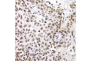 Immunohistochemistry of paraffin-embedded human well-differentiated squamous skin carcinoma using PHIP antibody (ABIN5974339) at dilution of 1/100 (40x lens). (PHIP anticorps)