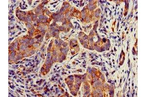 Immunohistochemistry of paraffin-embedded human pancreatic cancer using ABIN7171684 at dilution of 1:100 (TECPR2 anticorps  (AA 516-783))