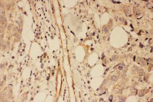 Anti-PSD95 antibody, IHC(P) IHC(P): Human Mammary Cancer Tissue