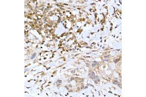 Immunohistochemistry of paraffin-embedded human breast cancer using TFEB Rabbit pAb (ABIN6128819, ABIN6149043, ABIN6149045 and ABIN6223149) at dilution of 1:100 (40x lens). (TFEB anticorps)