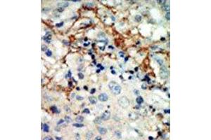Formalin-fixed and paraffin-embedded human cancer tissue reacted with the primary antibody, which was peroxidase-conjugated to the secondary antibody, followed by AEC staining. (EPH Receptor A3 anticorps  (N-Term))