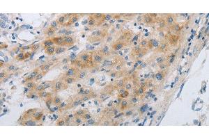 Immunohistochemistry of paraffin-embedded Human liver cancer using GJB6 Polyclonal Antibody at dilution of 1:30 (GJB6 anticorps)