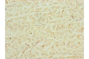 Immunohistochemistry of paraffin-embedded human gastric cancer using ABIN7151546 at dilution of 1:100