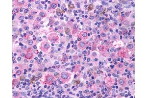 Anti-TBXA2R / Thromboxane Receptor antibody IHC of human Skin, Melanoma.