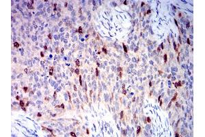 Immunohistochemical analysis of paraffin-embedded cervical cancer tissues using AURKA mouse mAb with DAB staining.