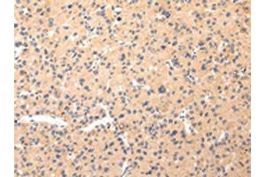 The image on the left is immunohistochemistry of paraffin-embedded Human liver cancer tissue using ABIN7190330(COL8A2 Antibody) at dilution 1/20, on the right is treated with synthetic peptide.