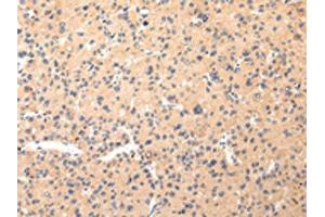 The image on the left is immunohistochemistry of paraffin-embedded Human liver cancer tissue using ABIN7190330(COL8A2 Antibody) at dilution 1/20, on the right is treated with synthetic peptide. (COL8a2 anticorps)