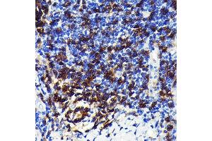 Immunohistochemistry of paraffin-embedded human lung cancer using CD4 Rabbit mAb (ABIN7266195) at dilution of 1:100 (40x lens). (CD4 anticorps)