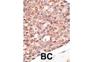 Formalin-fixed and paraffin-embedded human breast cancer tissue reacted with CRY2 polyclonal antibody  , which was peroxidase-conjugated to the secondary antibody, followed by DAB staining. (CRY2 anticorps  (C-Term))