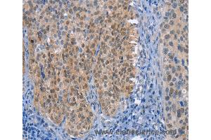 Immunohistochemistry of Human thyroid cancer using UCK1 Polyclonal Antibody at dilution of 1:50