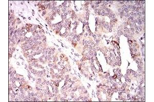 Immunohistochemical analysis of paraffin-embedded human ovarian cancer tissues using KIF11 mouse mAb with DAB staining. (KIF11 anticorps)