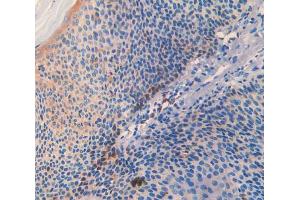 IHC-P analysis of skin cancer tissue, with DAB staining. (SLIT3 anticorps  (AA 1405-1512))