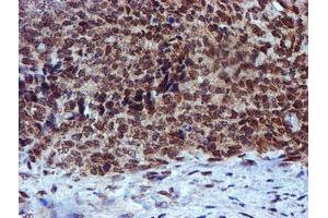 Immunohistochemical staining of paraffin-embedded Adenocarcinoma of Human breast tissue using anti-RFXANK mouse monoclonal antibody. (RFXANK anticorps)