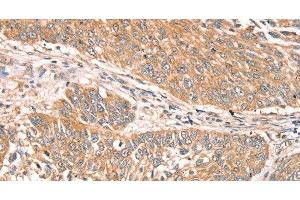 Immunohistochemistry of paraffin-embedded Human lung cancer using RPS6KA1 Polyclonal Antibody at dilution of 1:30 (RPS6KA1 anticorps)