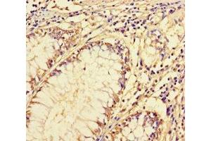 Immunohistochemistry of paraffin-embedded human colon cancer using ABIN7143489 at dilution of 1:100 (ARL16 anticorps  (AA 1-197))