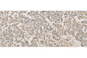 Immunohistochemistry of paraffin-embedded Human lung cancer tissue using FYTTD1 Polyclonal Antibody at dilution of 1:30(x200) (FYTTD1 anticorps)