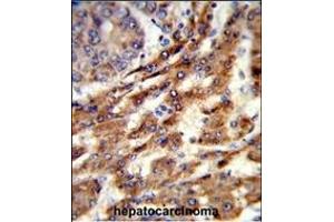 Formalin-fixed and paraffin-embedded human hepatocarcinoma reacted with ERGIC3 Antibody (N-term), which was peroxidase-conjugated to the secondary antibody, followed by DAB staining.