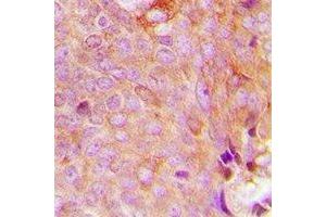 Immunohistochemical analysis of MRPS9 staining in human breast cancer formalin fixed paraffin embedded tissue section. (MRPS9 anticorps)