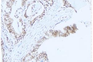 ABIN6275467 at 1/100 staining Human lung cancer tissue by IHC-P. (RAB37 anticorps  (C-Term))