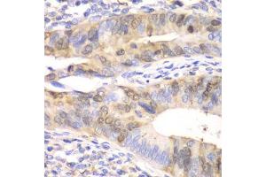Immunohistochemistry of paraffin-embedded human colon carcinoma using UBE2C antibody.