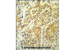 Formalin-fixed and paraffin-embedded human prostate carcinoma reacted with MGST2 Antibody (C-term),which was peroxidase-conjugated to the secondary antibody, followed by DAB staining. (MGST2 anticorps  (C-Term))