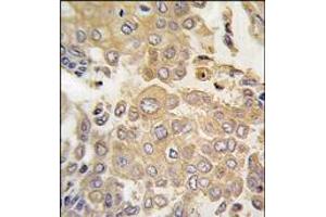 Formalin-fixed and paraffin-embedded human lung carcinoma tissue reacted with MAPK4 antibody (N-term), which was peroxidase-conjugated to the secondary antibody, followed by DAB staining. (MAPK4 anticorps  (N-Term))