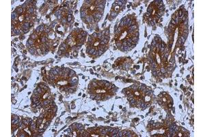 IHC-P Image Immunohistochemical analysis of paraffin-embedded human colon carcinoma, using alpha Tubulin, antibody at 1:500 dilution. (TUBA1B anticorps)