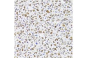 Immunohistochemistry of paraffin-embedded human B cell lymphoma using TP53 Antibody (ABIN5971632) at dilution of 1/100 (40x lens). (p53 anticorps)