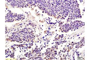 Formalin-fixed and paraffin embedded human lung carcinoma labeled with Anti-Integrin alpha 7/ITGA7 Polyclonal Antibody, Unconjugated (ABIN734858) at 1:200 followed by conjugation to the secondary antibody and DAB staining. (ITGA7 anticorps  (AA 701-800))