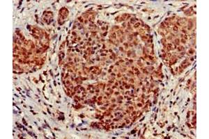 Immunohistochemistry of paraffin-embedded human ovarian cancer using ABIN7170803 at dilution of 1:100 (STOML3 anticorps  (AA 205-291))