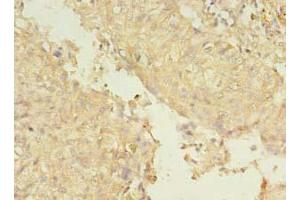 Immunohistochemistry of paraffin-embedded human lung cancer using ABIN7151226 at dilution of 1:100