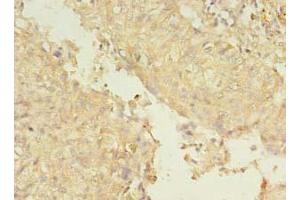 Immunohistochemistry of paraffin-embedded human lung cancer using ABIN7151226 at dilution of 1:100 (SMURF2 anticorps  (AA 1-748))