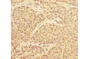 Immunohistochemistry of paraffin-embedded human ovarian cancer using ABIN7174174 at dilution of 1:100